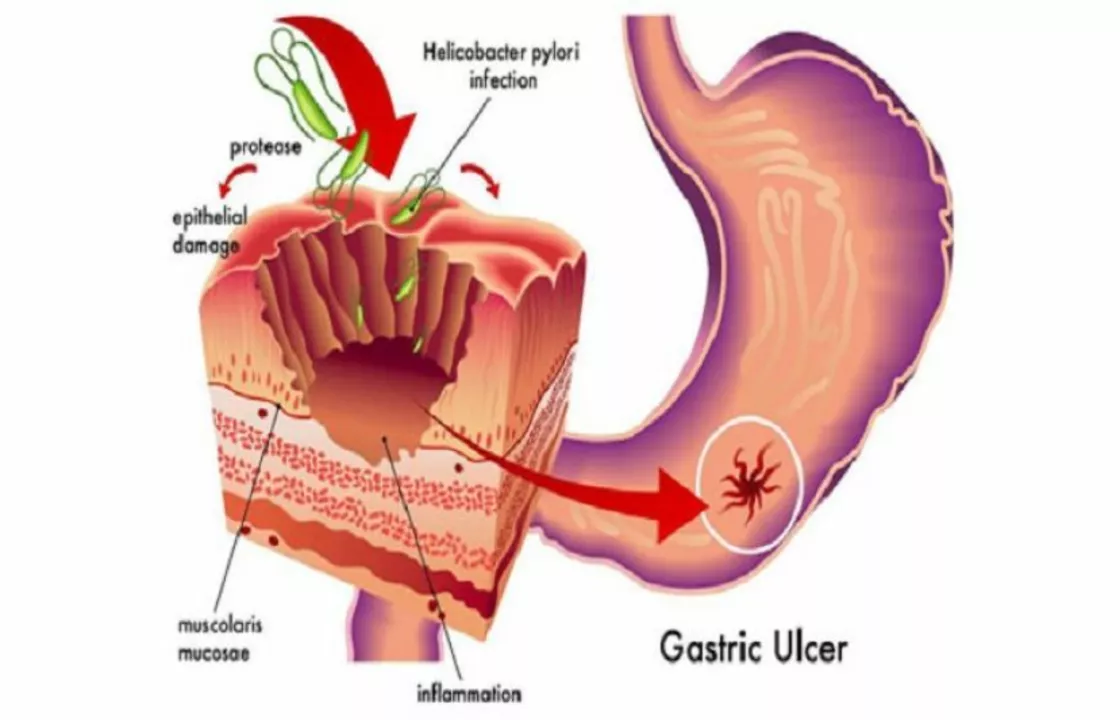 The Connection between Epigastric Pain and H. Pylori Infection
